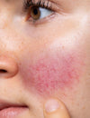 Skin Series - Rosacea Prone