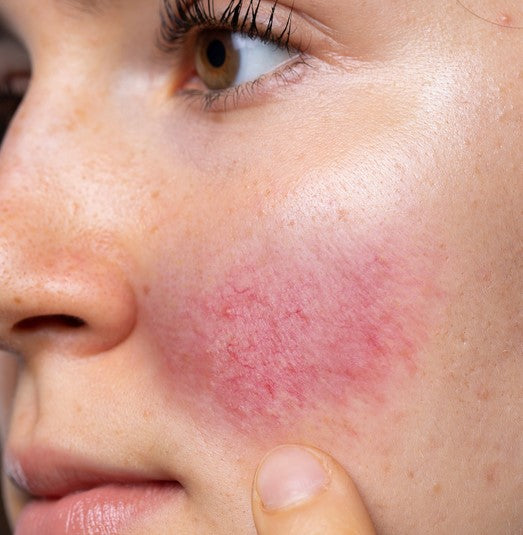 glutathione and rosacea Skin Series - Rosacea Prone